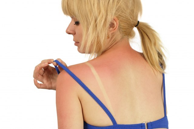 Što više puta izgorite na suncu, veće su šanse da dobijete rak kože